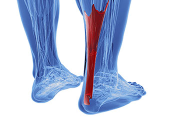 Achilles tendonitis treatment in the Harris County, TX: Willowbrook, Lakewood Forest, Jersey Village, Louetta, Klein, Hedwig Village, Cypress (Bridgeland), Memorial, Copperfield Place (Park Row), and Northwest Houston areas