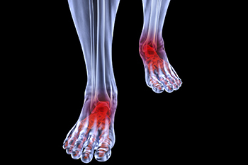 Arthritic foot and ankle care treatment, foot arthritis treatment in the Harris County, TX: Willowbrook, Lakewood Forest, Jersey Village, Louetta, Klein, Hedwig Village, Cypress (Bridgeland), Copperfield Place (Park Row), and Northwest Houston  areas