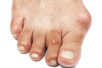Bunions treatment in the Harris County, TX: Willowbrook, Lakewood Forest, Jersey Village, Louetta, Klein, Hedwig Village, Cypress (Bridgeland), Memorial, Copperfield Place (Park Row), and Northwest Houston areas