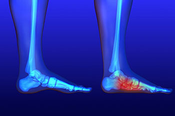 Flat feet and Fallen Arches treatment, Flatfoot Deformity Treatment in the Harris County, TX: Willowbrook, Lakewood Forest, Jersey Village, Louetta, Klein, Hedwig Village, Cypress (Bridgeland), Memorial, Copperfield Place (Park Row), and Northwest Houston areas