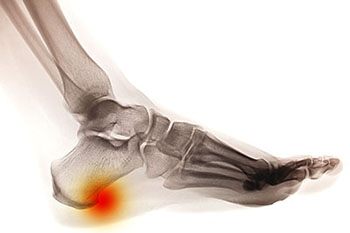 Heel spurs treatment in the Harris County, TX: Willowbrook, Lakewood Forest, Jersey Village, Louetta, Klein, Hedwig Village, Cypress (Bridgeland), Memorial, Copperfield Place (Park Row), and Northwest Houston areas