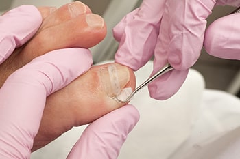 Ingrown toenails treatment in the Harris County, TX: Willowbrook, Lakewood Forest, Jersey Village, Louetta, Klein, Hedwig Village, Cypress (Bridgeland), Copperfield Place (Park Row), and Northwest Houston areas
