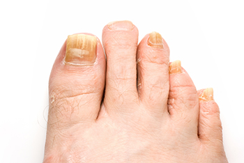 Fungal toenails, toenail fungus diagnosis and treatment in the Harris County, TX: Willowbrook, Lakewood Forest, Jersey Village, Louetta, Klein, Hedwig Village, Cypress (Bridgeland), Copperfield Place (Park Row), and Northwest Houston areas
