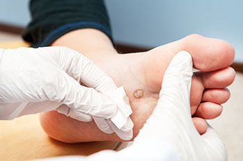 Plantar warts treatment in the Harris County, TX: Willowbrook, Lakewood Forest, Jersey Village, Louetta, Klein, Hedwig Village, Cypress (Bridgeland), Copperfield Place (Park Row), and Northwest Houston areas