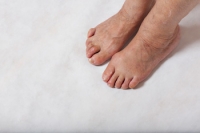 Bunion Surgery May Help Provide Pain-Free Feet